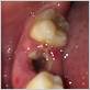 gum disease after tooth extraction