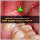 gum disease after wisdom tooth extraction