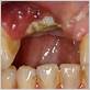 gum disease alveolar bone graft
