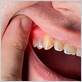 gum disease anchorage