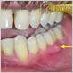 gum disease and abscess