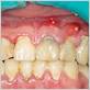 gum disease and afib
