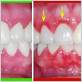 gum disease and bv