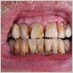 gum disease and cancer link