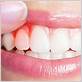 gum disease and cancer risk