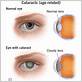 gum disease and cataracts