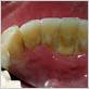 gum disease and cavities