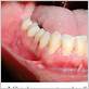 gum disease and crohn's