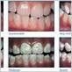 gum disease and fluoride