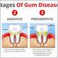 gum disease and liver problems