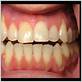 gum disease and receding gums