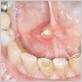 gum disease and salivary glands