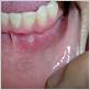 gum disease and sore tongue