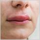 gum disease and swollen lips