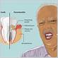 gum disease and upper jaw bone