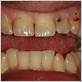 gum disease around crowns