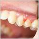 gum disease around one tooth