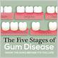 gum disease as it worsens progresses from