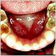 gum disease back molar