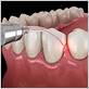 gum disease bacteria treatment