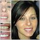 gum disease before after