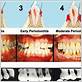 gum disease before and after waterflossing