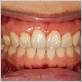 gum disease behind front teeth