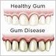 gum disease bellingham wa