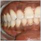 gum disease black gums