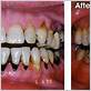 gum disease black tartar on teeth