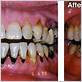 gum disease black teeth