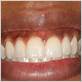 gum disease bleach