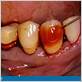 gum disease bleach povidone iodine