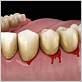 gum disease bleeding at night