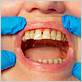 gum disease boise id