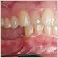 gum disease bone deterioration