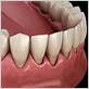 gum disease bottom teeth