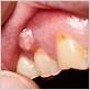 gum disease bump in mouth