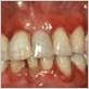 gum disease burlington