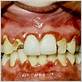 gum disease called pyrea