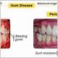 gum disease carbohydrates