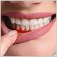 gum disease carrollwood fl