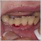 gum disease caused by vitamin deficiency