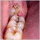 gum disease caused by wisdom teeth