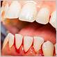 gum disease causes bleeding gums