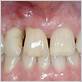 gum disease causing bone loss