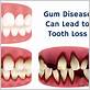 gum disease causing tooth loss