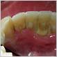 gum disease cavities bad breath