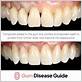 gum disease composite bonding