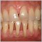 gum disease dentist atlanta